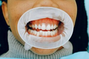 Canadian Dental Care Plan