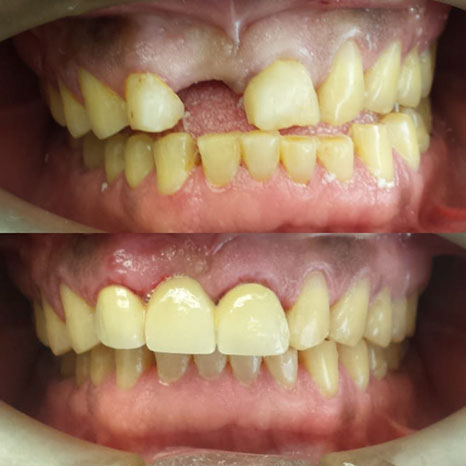 teeth fix dental